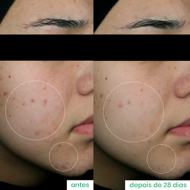 Comparação de antes e depois de 28 dias usando o Super Ácido Salicílico 2% da Sallve. À esquerda, pele com cravos e espinhas inflamadas; à direita, melhora visível na textura e redução das lesões de acne.