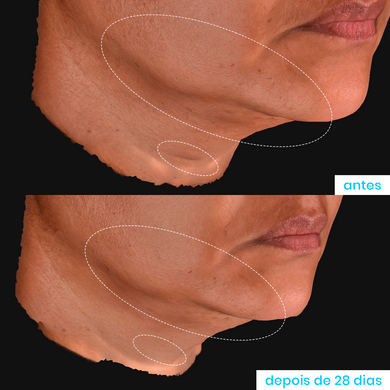 Comparação de antes e depois do uso do Super Pró-Colágeno 10% da Sallve mostrando a redução da flacidez e melhora da firmeza na região do queixo após 28 dias de uso.