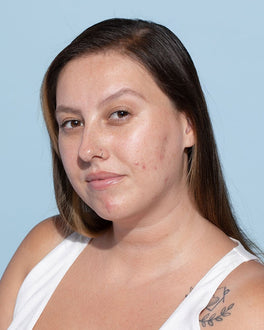 Estresse causa acne sim! Entenda por que e aprenda a tratar