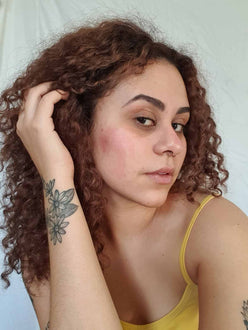 Acne da mulher adulta: quais são as causas e como tratar