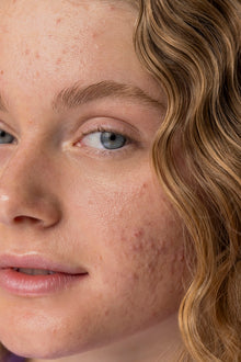 Acne: o que é, como tratar e quando procurar um médico