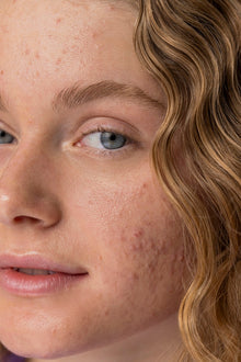 Acne: o que é, como tratar e quando procurar um médico