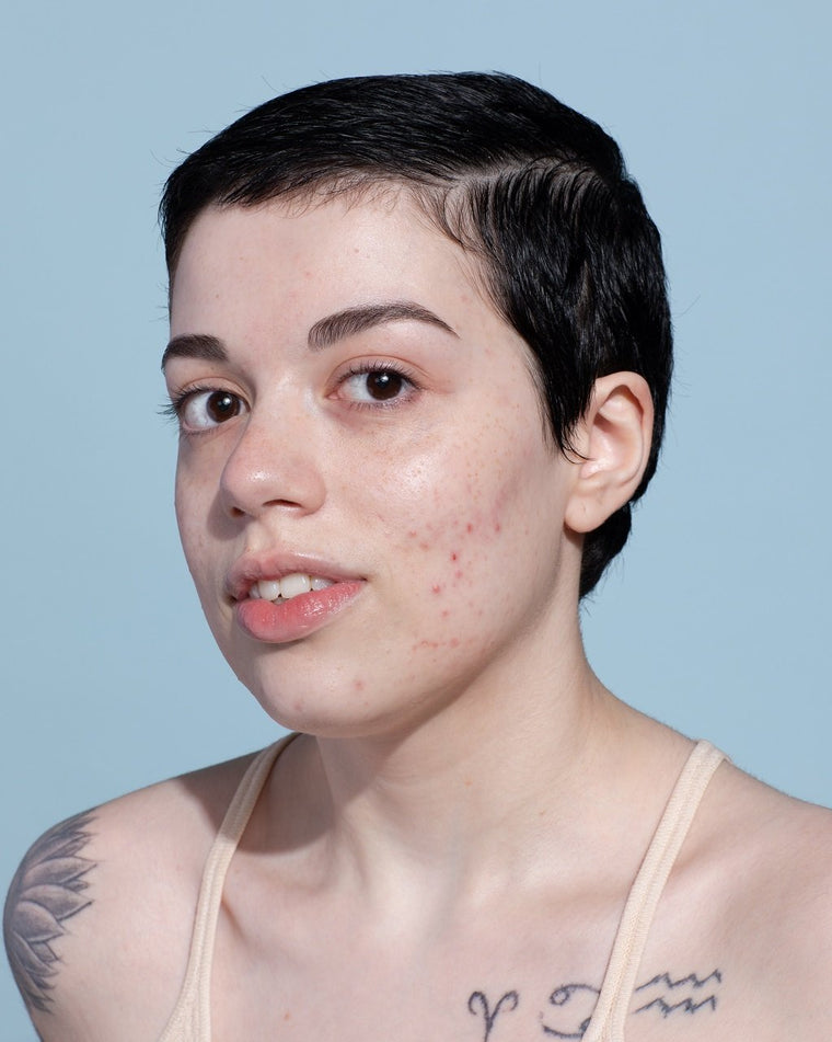 graus de acne