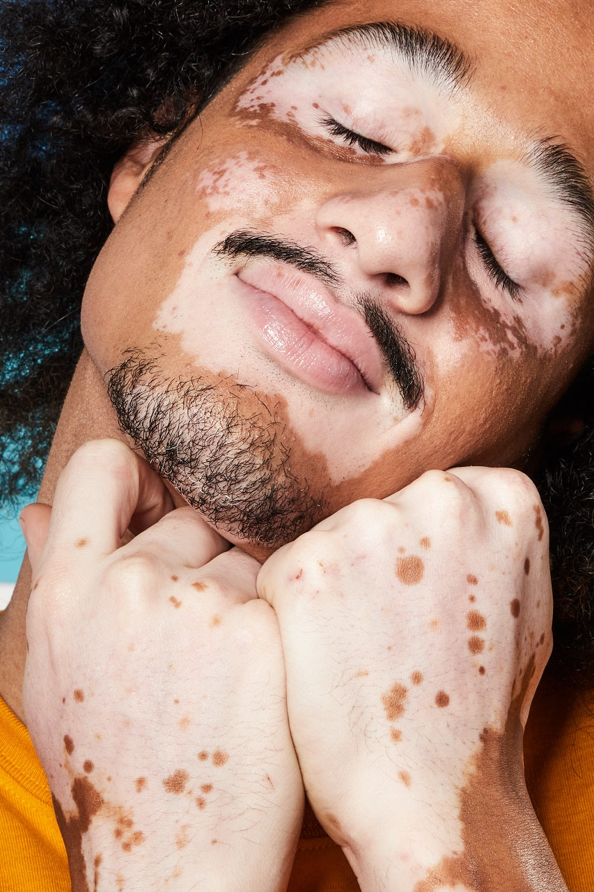 Vitiligo: o que é, quais as causas e como é o tratamento
