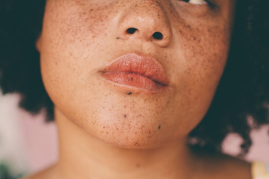 Como é o tratamento de manchas e por que é a longo prazo?