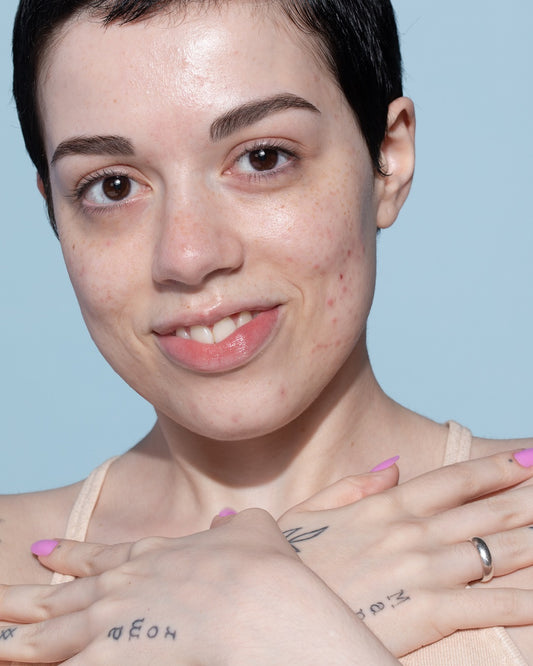 Cravos e espinhas: melhores ativos para combater e prevenir