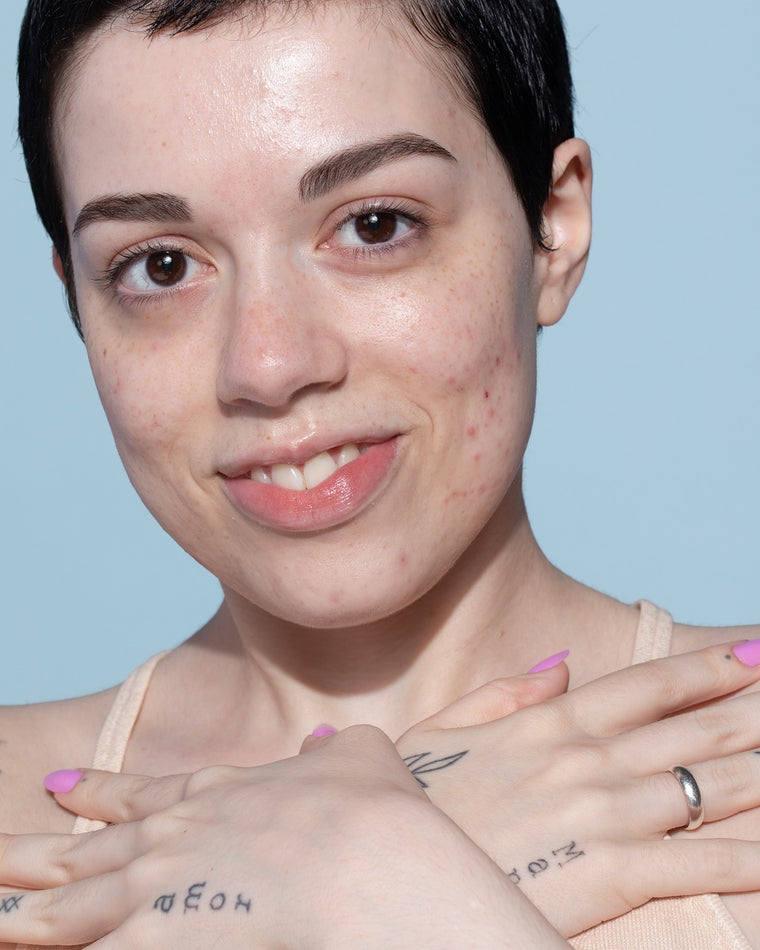 Cravos e espinhas: melhores ativos para combater e prevenir