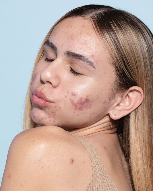 maquiagem causa acne