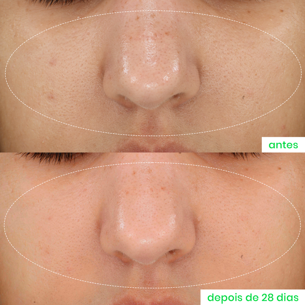 Comparativo de pele antes e depois de 28 dias de uso do Super Ácido Glicólico 10% da Sallve, mostrando redução de poros e oleosidade.