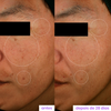Antes e depois de 28 dias usando a Super Niacinamida 20% da Sallve