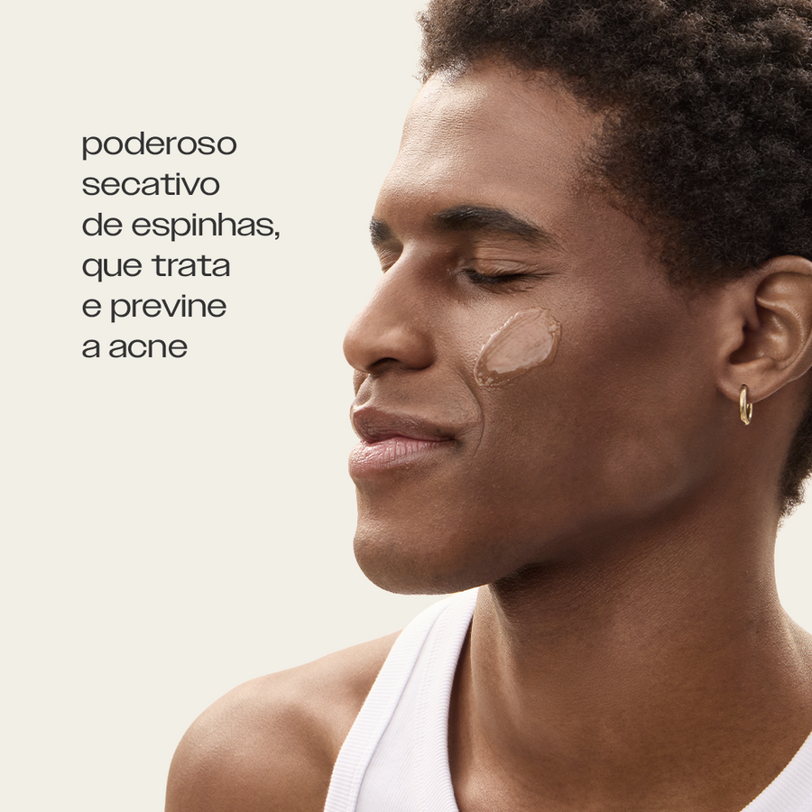 Sérum Antiacne Sallve aplicado no rosto – poderoso secativo de espinhas que trata e previne a acne